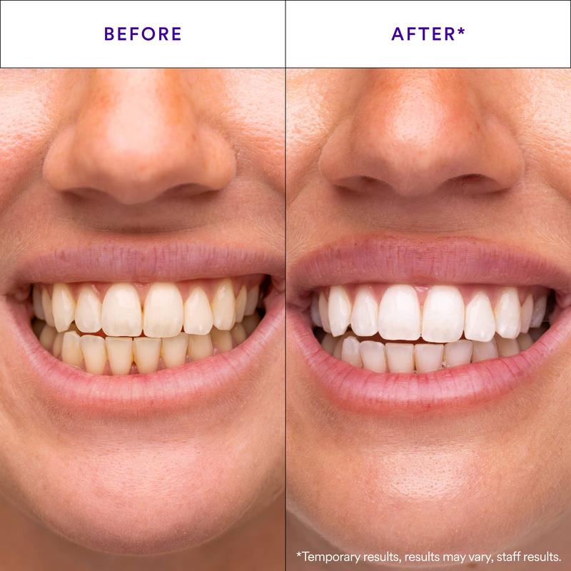 Teeth Whitening Strips